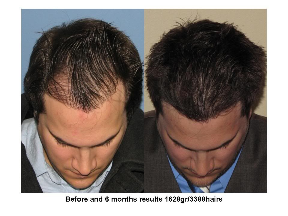 how long after quitting finasteride